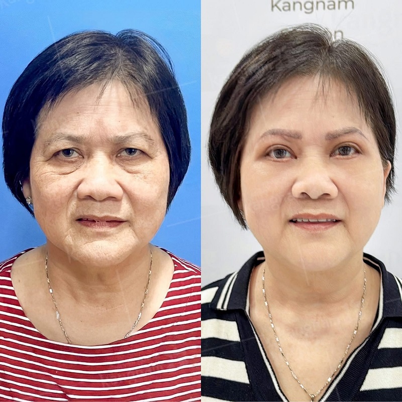 Khách hàng sau khi nâng cung chân mày