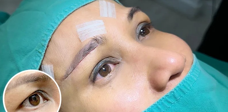 Hiệu quả duy trì được từ 1 - 2 năm