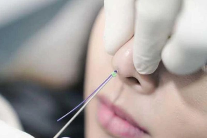 Cấy chỉ mũi nhiều lần tốn kém chi phí không thua gì một lần nâng mũi