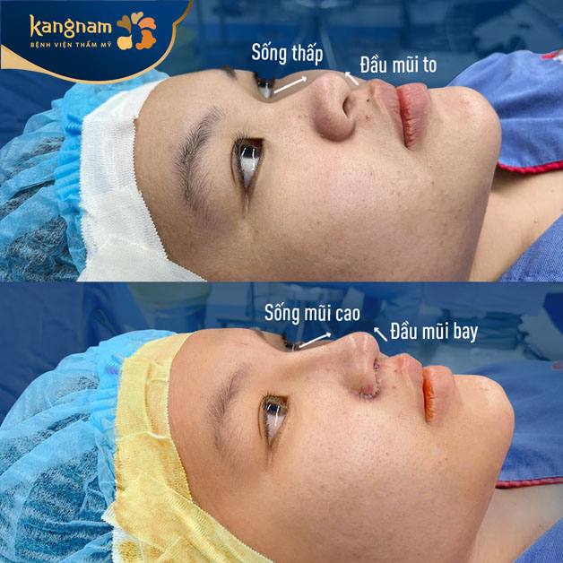 Cận cảnh dáng mũi sau khi vừa thực hiện