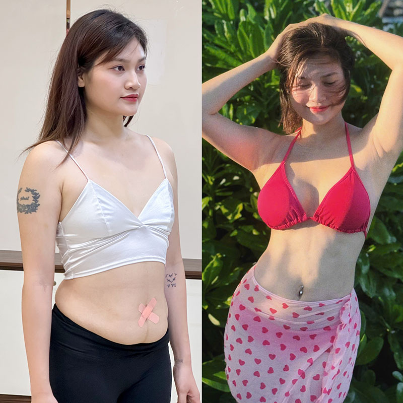 Ngực đầy đặn, cân đối sau phẫu thuật nâng ngực tại Kangnam