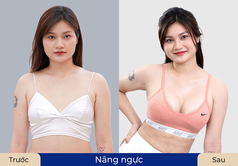 Chọn size túi ngực cần cân nhắc theo nhiều yếu tố