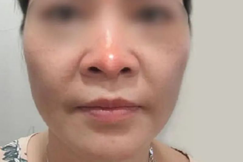 Cơ địa nhạy cảm, không hợp sụn