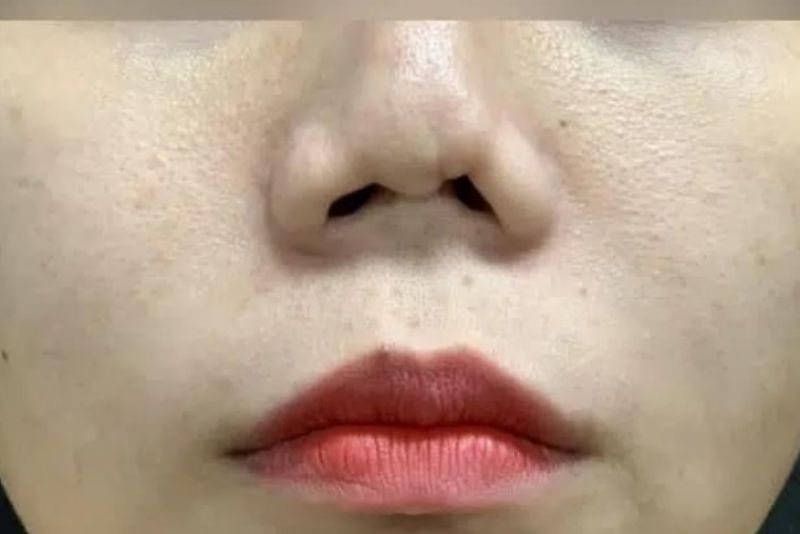Mũi hỏng do bác sĩ thực hiện sai kỹ thuật
