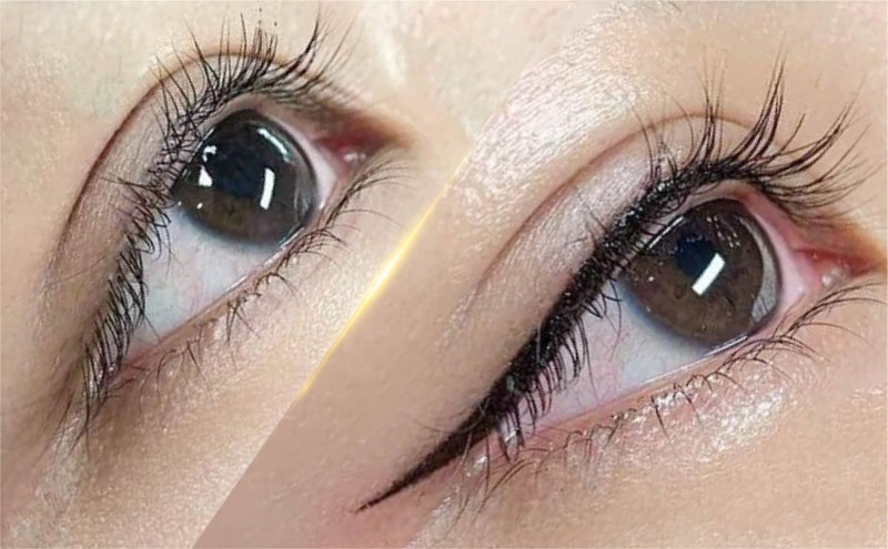 Mí mắt cân đối, sắc nét sau khi thực hiện