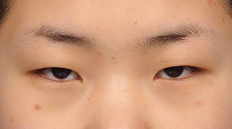 Sụp mí mắt có thể là dấu hiệu của nhiều bệnh lý