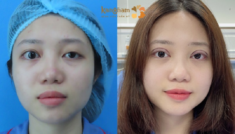 Cắt mí giúp khắc phục hiệu quả tình trạng sụp mí