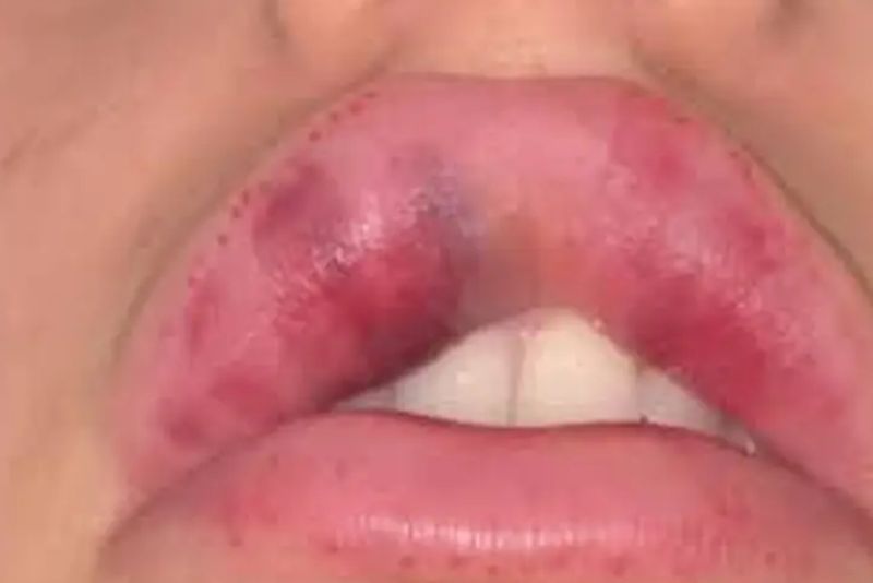 Tiêm filler môi sai kỹ thuật có thể gây tác hại
