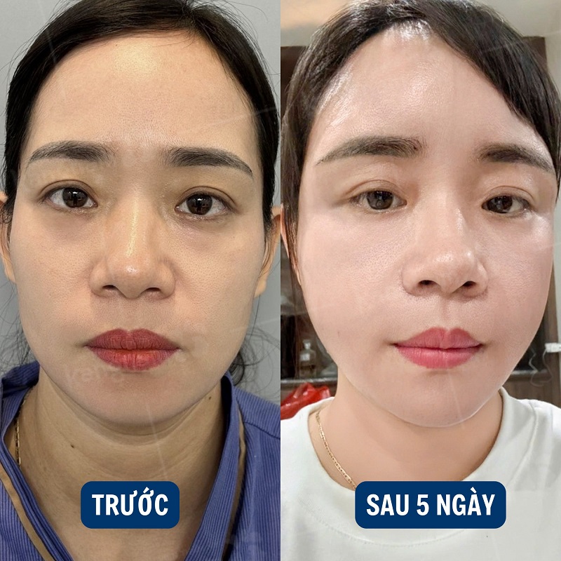 Mỡ sau cấy sẽ bị ngót đi một phần