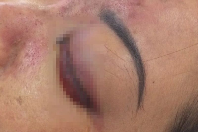 Sưng bầm do tiêm sai lớp mô