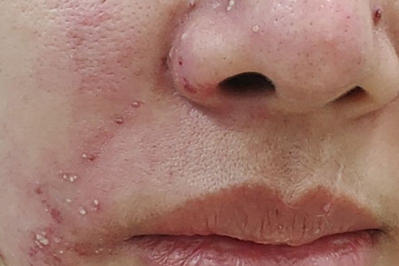 Dị ứng khi sử dụng filler kém chất lượng