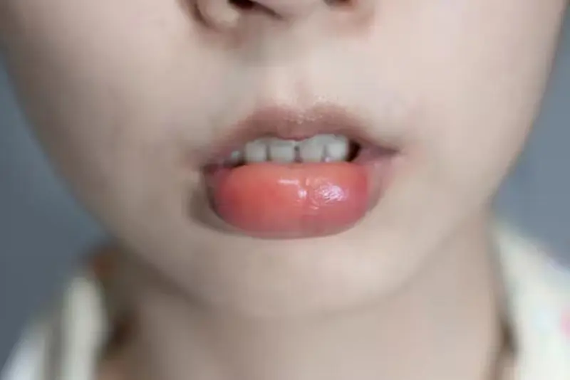 Sưng sau tiêm filler môi