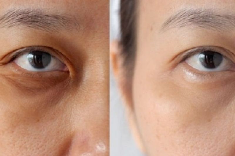 Gương mặt trẻ trung hơn sau tiêm filler