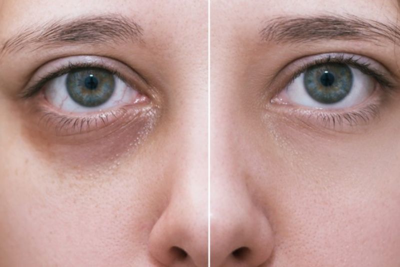 Tiêm filler vùng mắt an toàn khi thực hiện đúng kỹ thuật