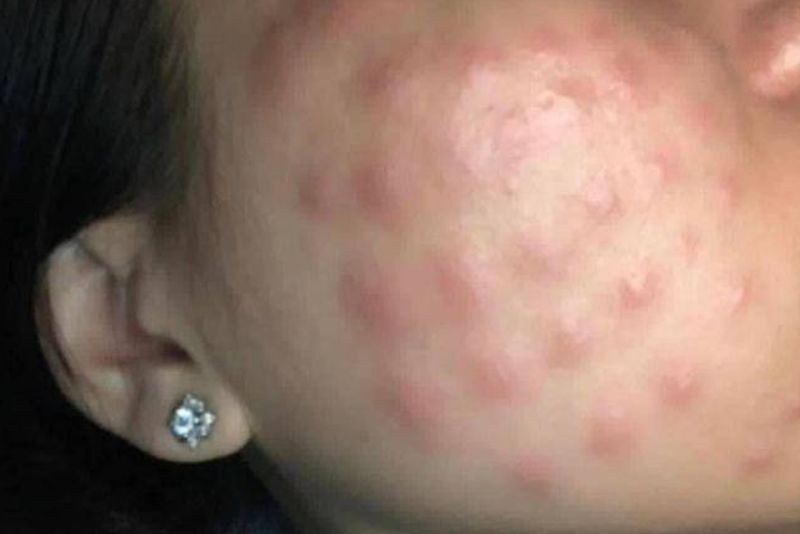 Sưng đỏ sau tiêm meso cần thăm khám ngay