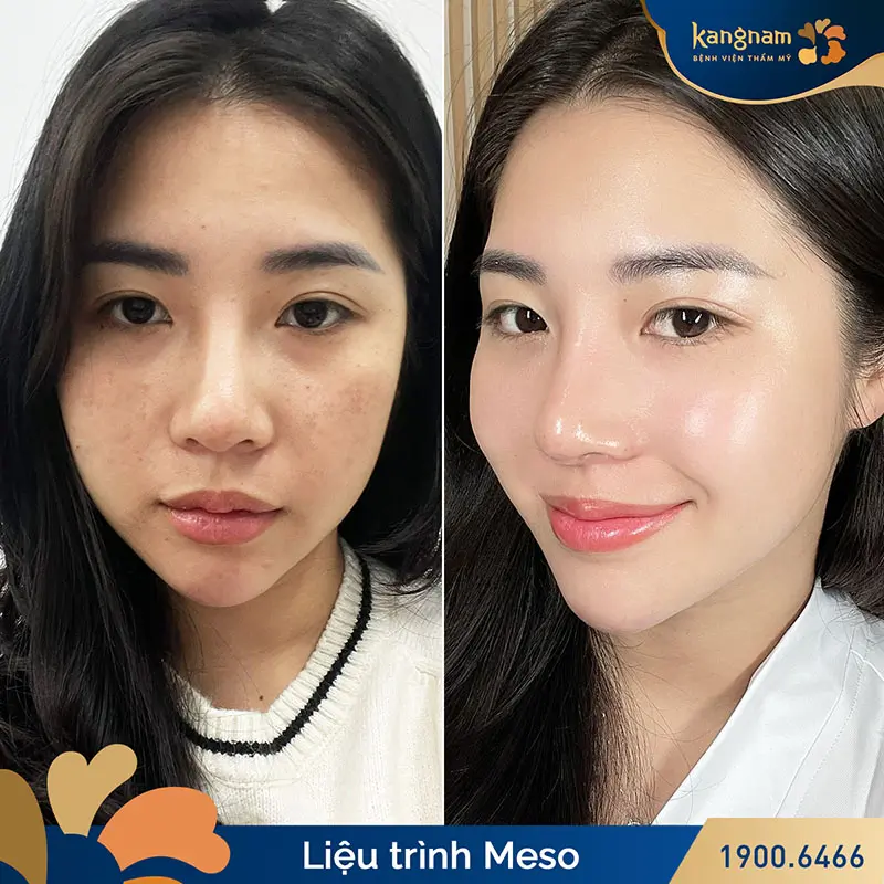 Kết quả sau khi tiêm meso căng bóng da tại Kangnam