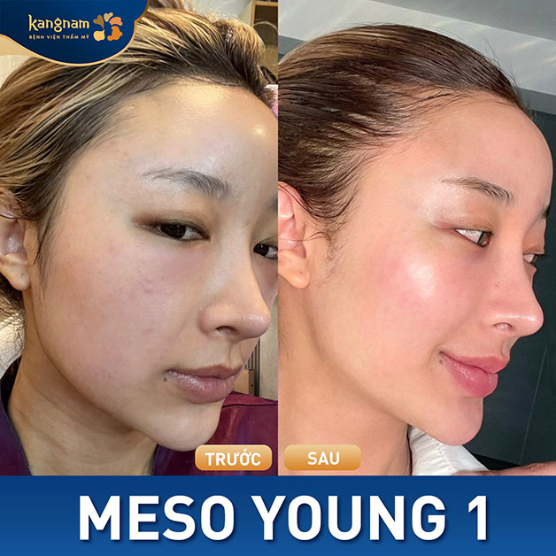 Tiêm meso giúp da sẽ khít lỗ chân lông