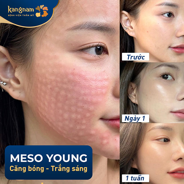Khách hàng tiêm meso tại Kangnam sở hữu da căng bóng, không tác dụng phụ