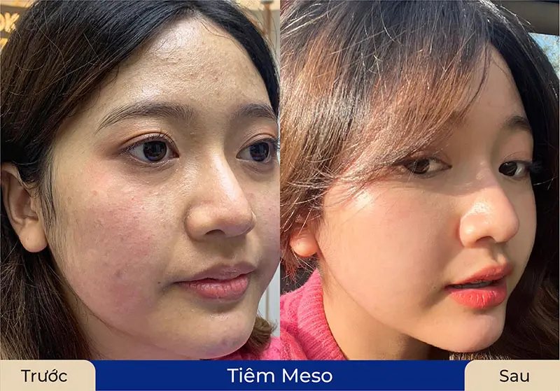 Da căng bóng rõ rệt sau liệt trình meso