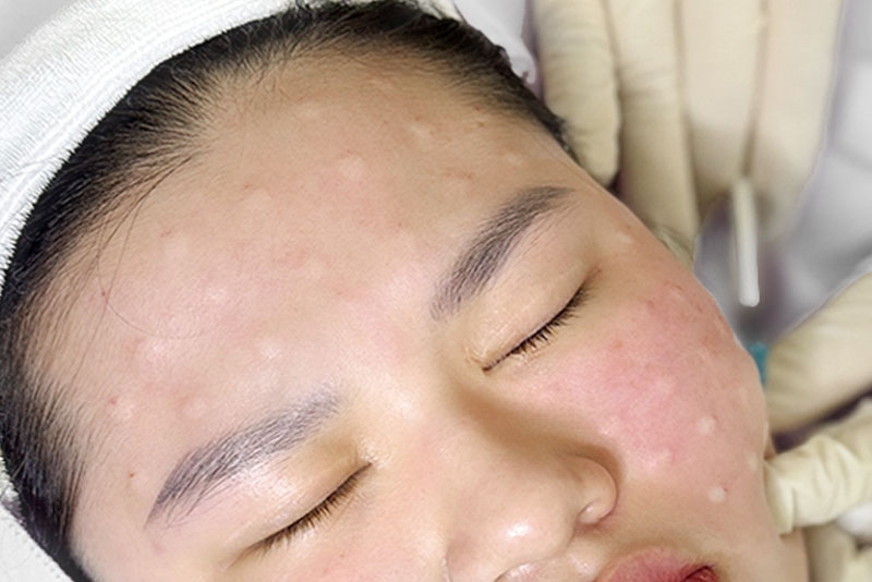 Kangnam thực hiện quy trình tiêm meso an toàn