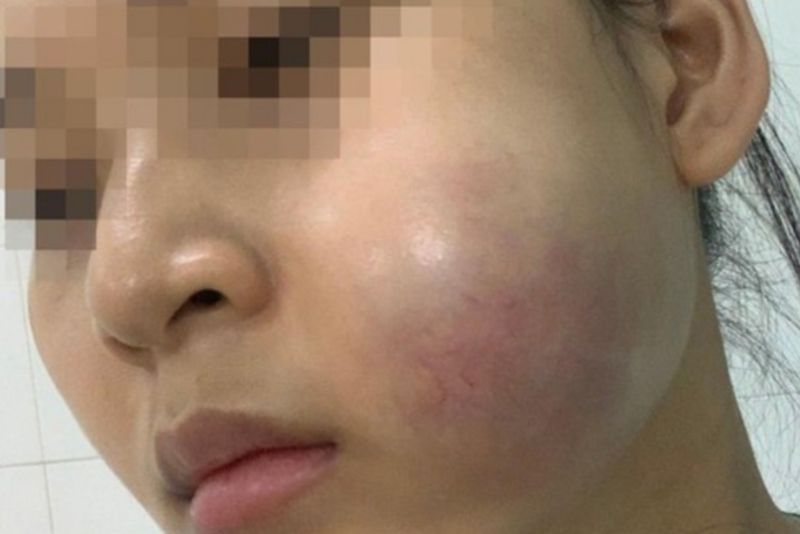 Sưng tím bất thường do tiêm tan sai cách