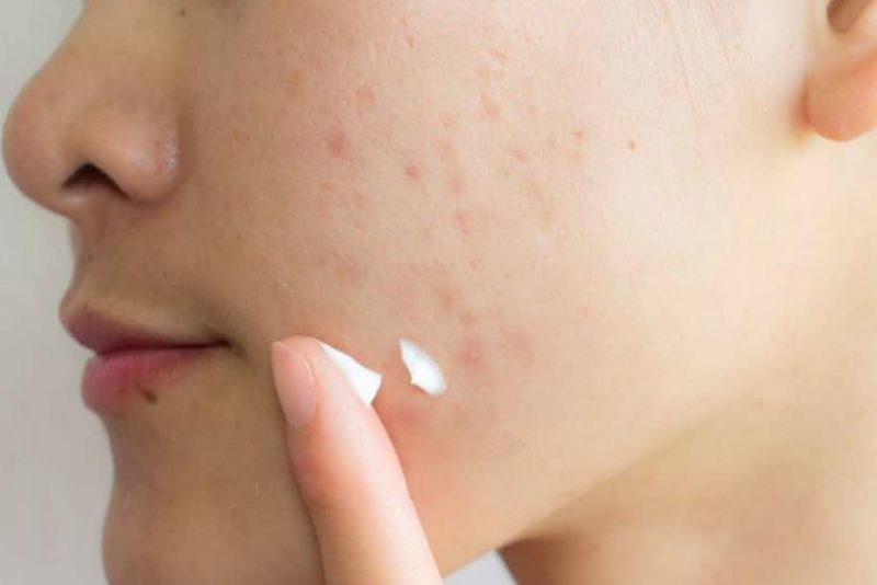 Trị thâm sẹo mụn bằng thuốc bôi tại nhà