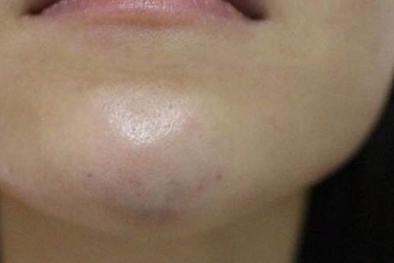 Vùng da tiêm filler bị tím có thể là bình thường