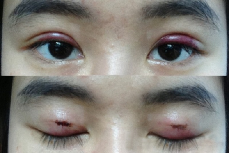 Mí mắt nhiễm trùng, tụ máu kéo dài