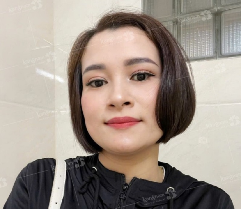 Nếp mí đã dần vào form ổn định hơn