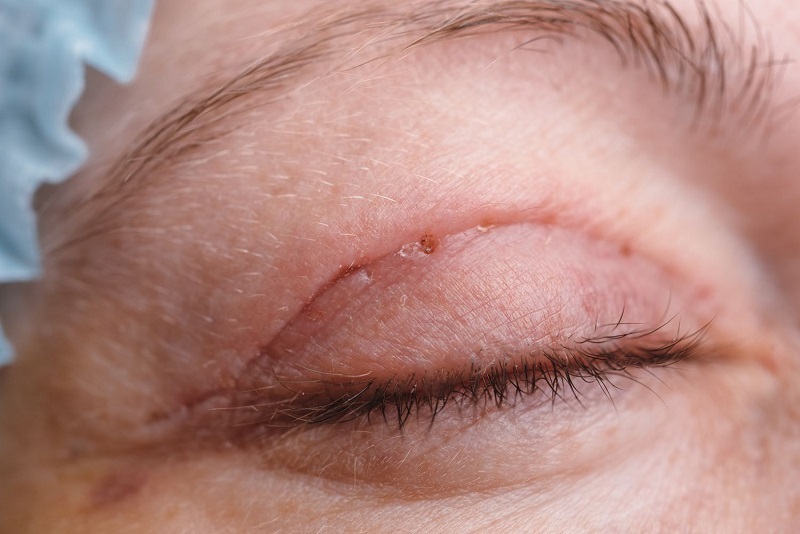 Tay nghề bác sĩ không đảm bảo có thể gây ra biến chứng khi cắt mí
