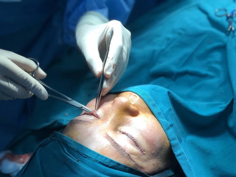 Khách hàng nên đến cơ sở thẩm mỹ uy tín để bác sĩ tiến hành chỉnh sửa