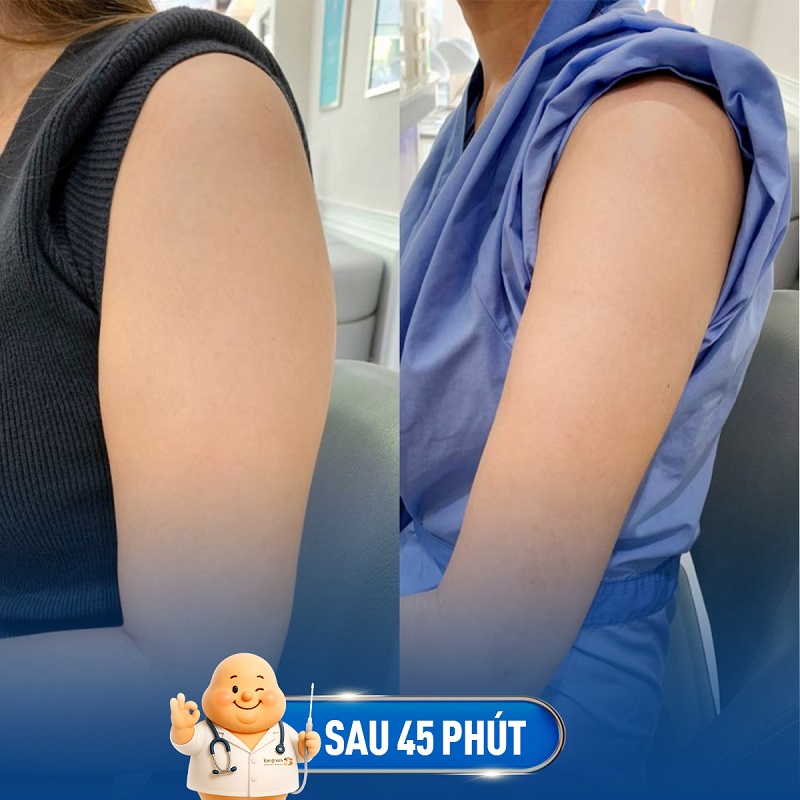 Hút mỡ bắp tay giúp loại bỏ mỡ thừa nhanh chóng