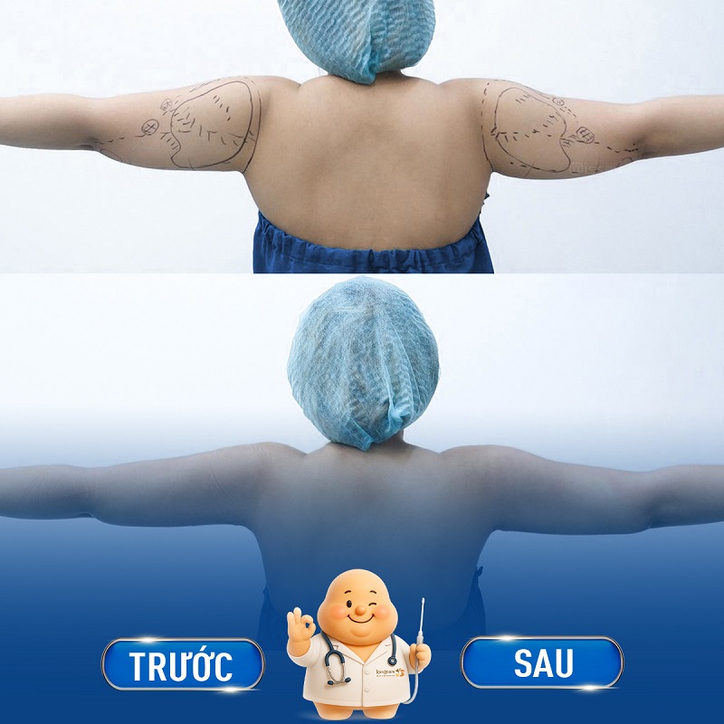 Thời gian thực hiện hút mỡ nhanh, duy trì hiệu quả lâu dài