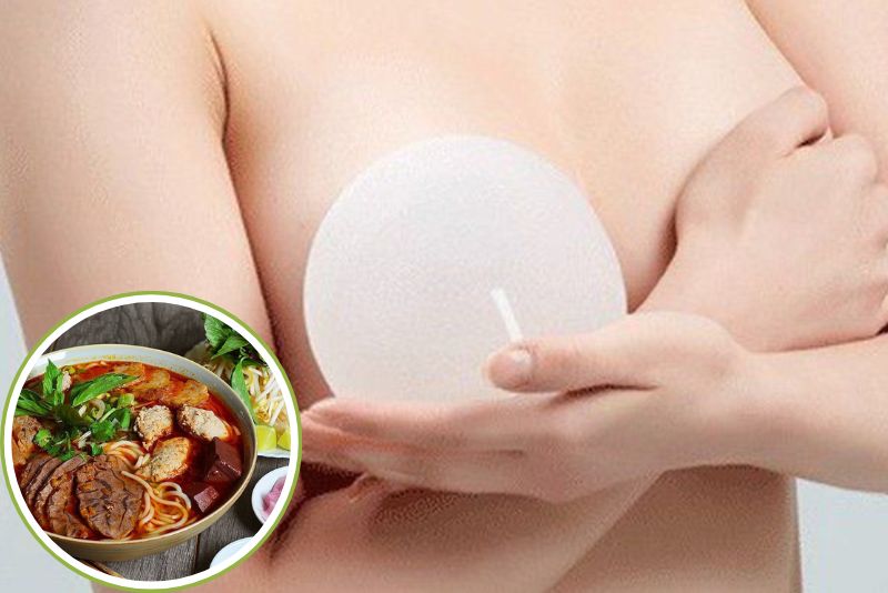 Sau nâng ngực có thể ăn bún