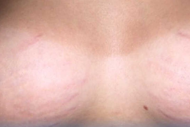Vết rạn dần chuyển sang màu trắng
