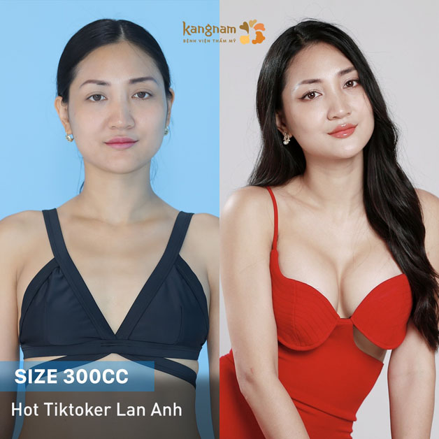 Khách hàng nâng ngực tại Kangnam sở hữu vòng 1 quyến rũ