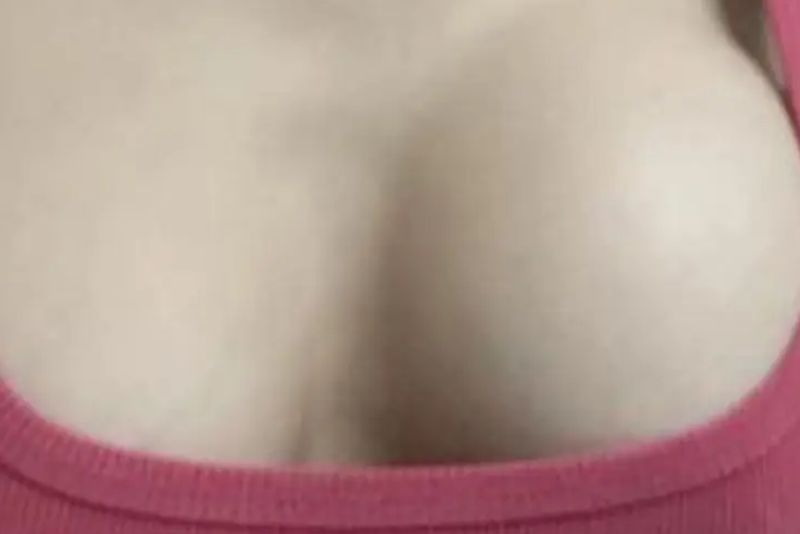 Nâng ngực bị lộ túi