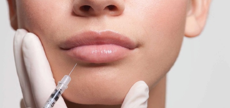 Tiêm filler giúp môi căng mọng