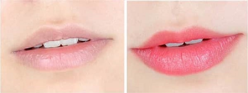Môi lên màu ổn định mới lên tiêm filler