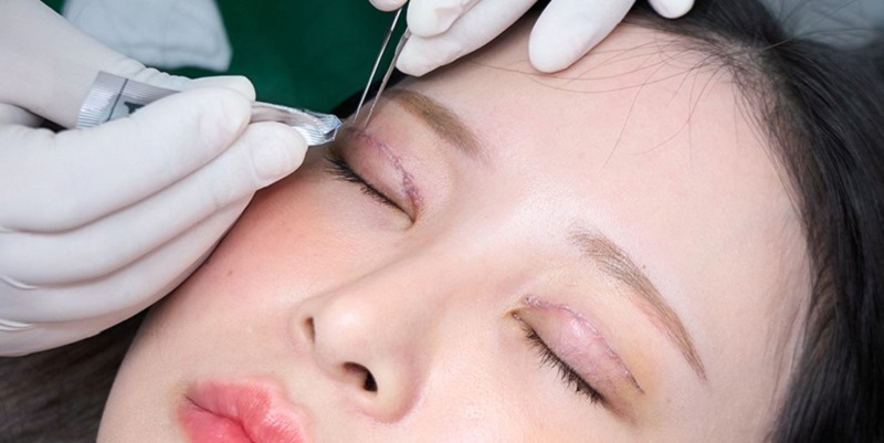 Kỹ thuật cắt mí sai cách có thể gây phù kết mạc