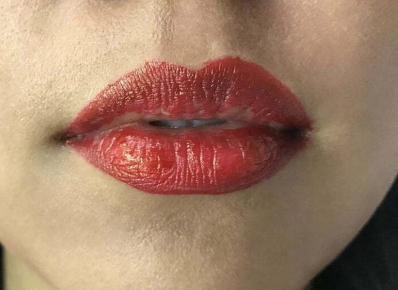 Môi bị sưng tấy, lên màu không đều, loang lổ