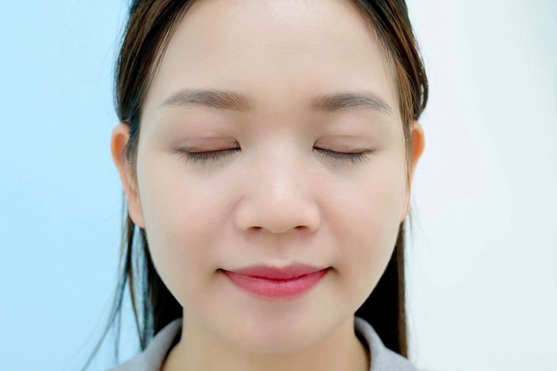 Vết sẹo cắt mí sẽ mờ dần sau 3 - 6 tháng