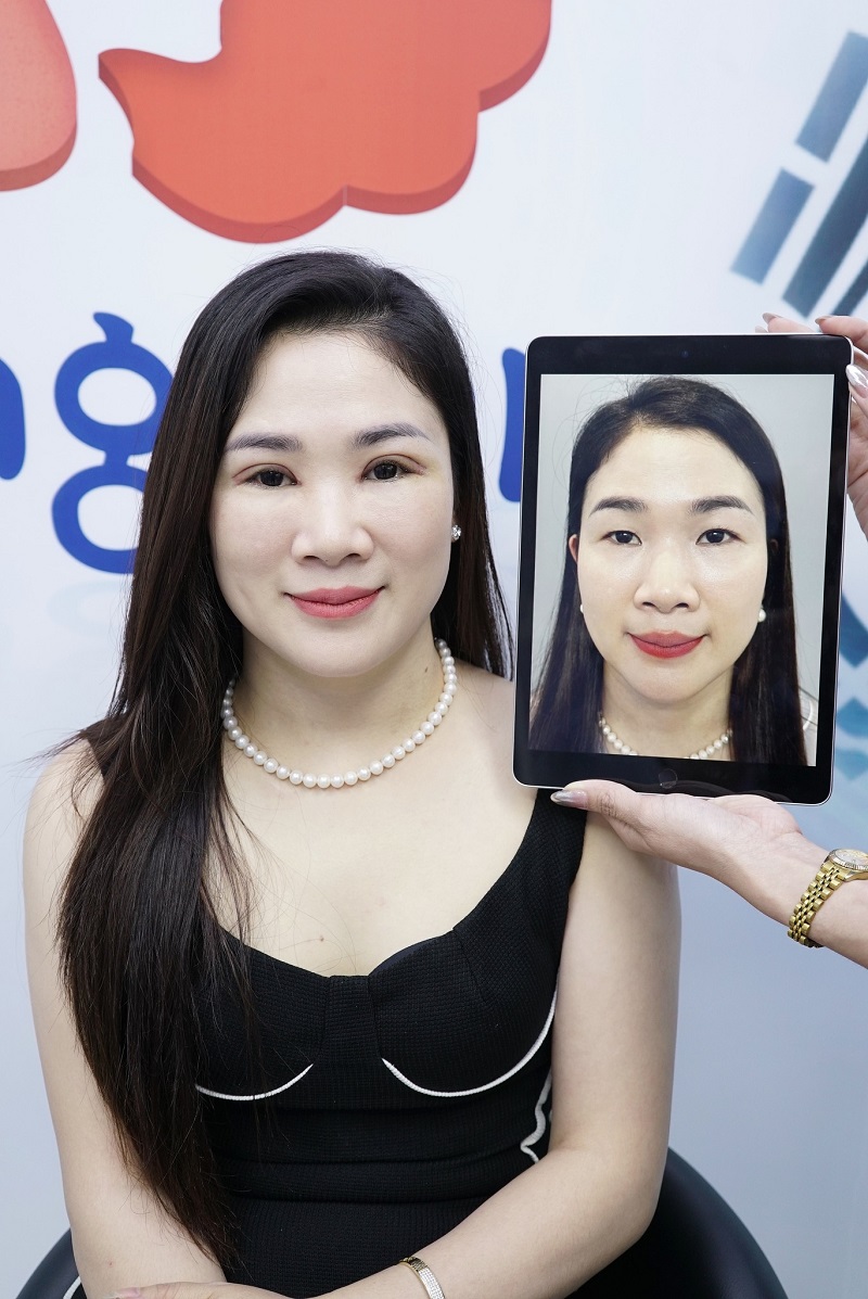 Cơ địa khách hàng bị sẹo lồi có thể tăng nguy cơ để lại sẹo