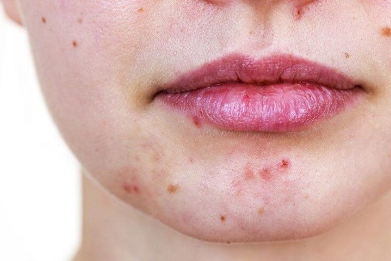 Có nhiều phương pháp trị thâm quanh miệng
