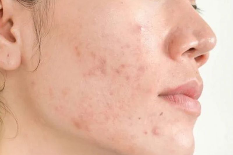 Thâm mụn có khả năng tự mờ nhưng cần nhiều thời gian