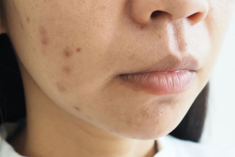 Tác động từ môi trường ảnh hưởng lớn đến kết quả trị thâm mụn