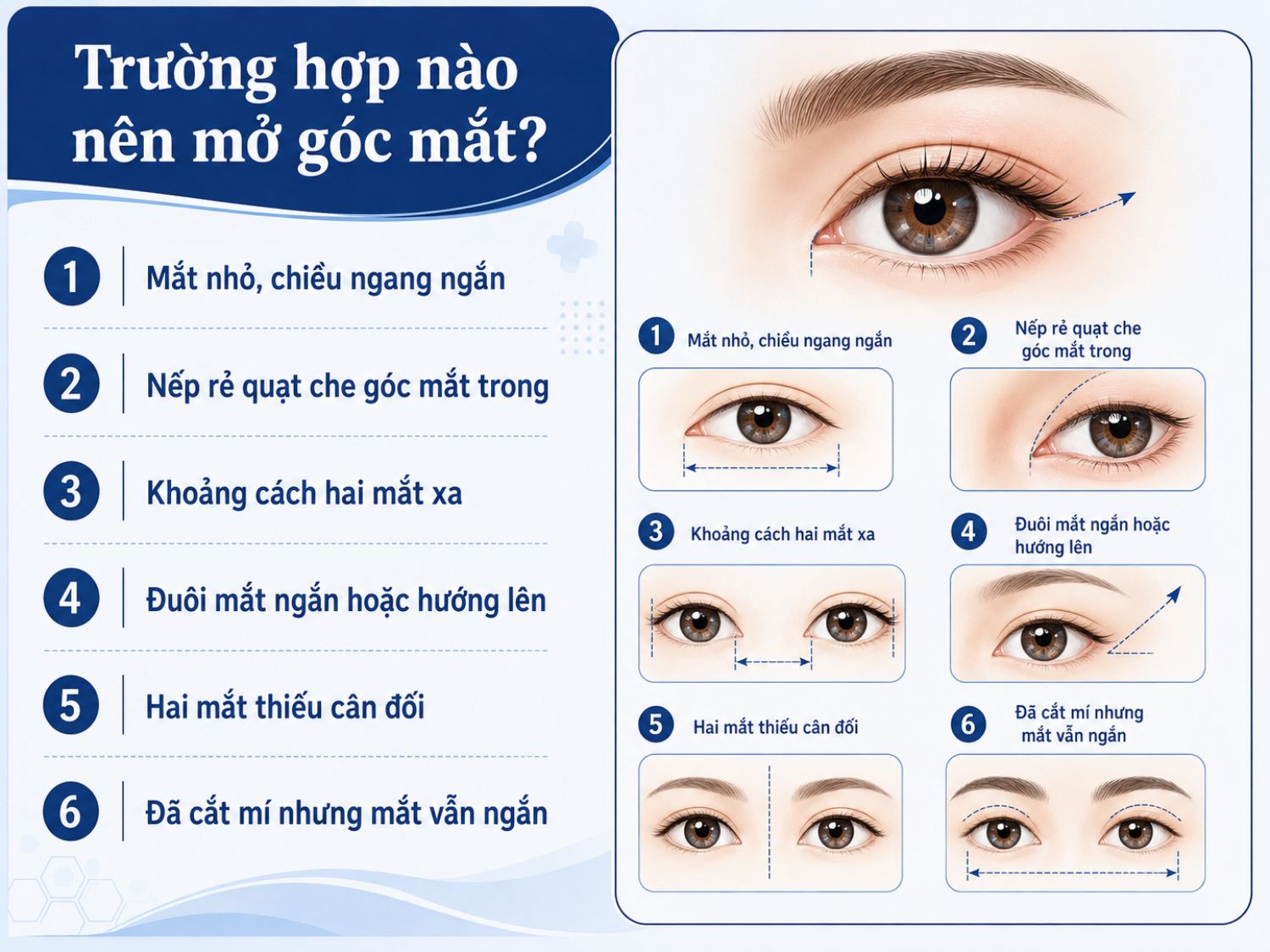 Mở góc mắt có thể phù hợp với người có mắt nhỏ, nếp rẻ quạt rõ, khoảng cách hai mắt xa, đuôi mắt ngắn hoặc trường hợp đã cắt mí nhưng chiều ngang mắt vẫn hạn chế.