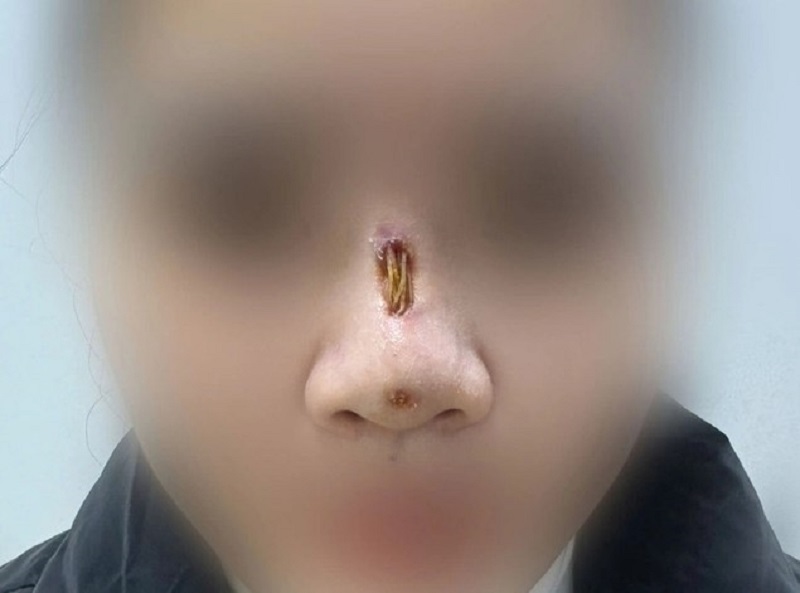 Nâng mũi bằng chỉ bị nhiễm trùng, hoại tử