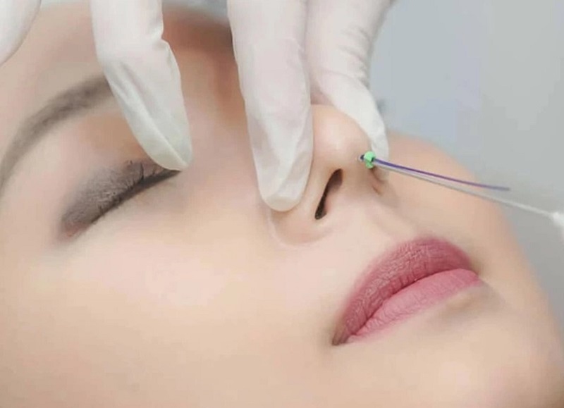 Tại Kangnam quy trình nâng mũi bằng chỉ diễn ra chuẩn y khoa