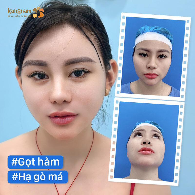 Gò má cân đối, tự nhiên